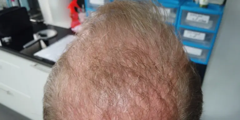 Mixed grafting poils et cheveux à Alès