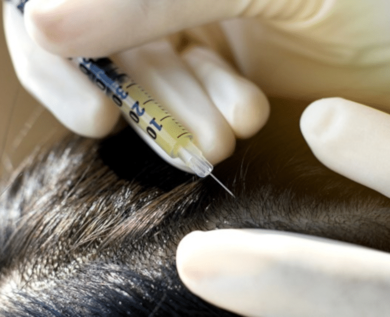 PRP Traitement anti-chute de cheveux à Levallois-Perret