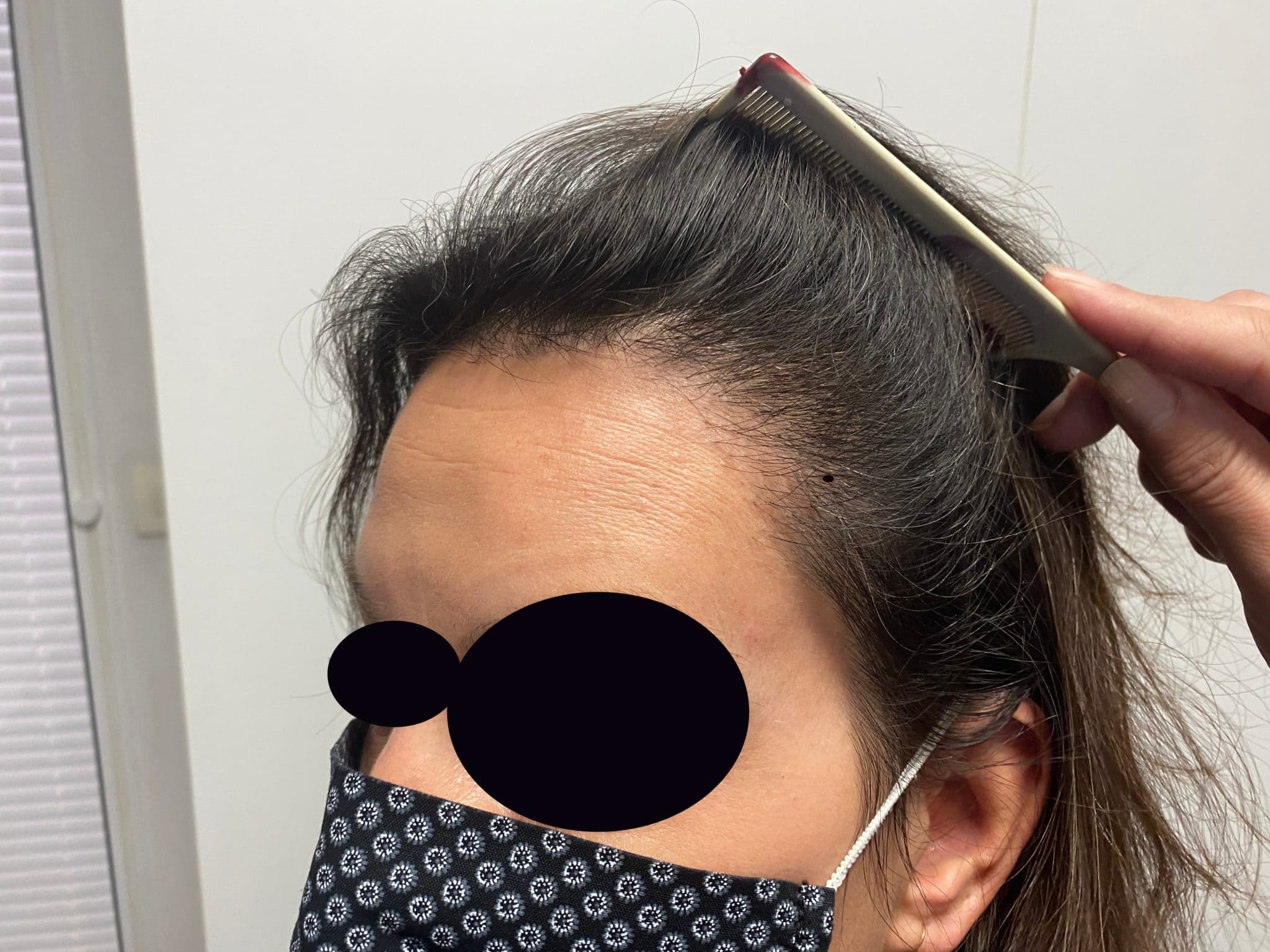 Greffe cheveux femme proche Paris Prix AvantAprès Témoignages