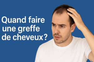 Quand faire une greffe de cheveux