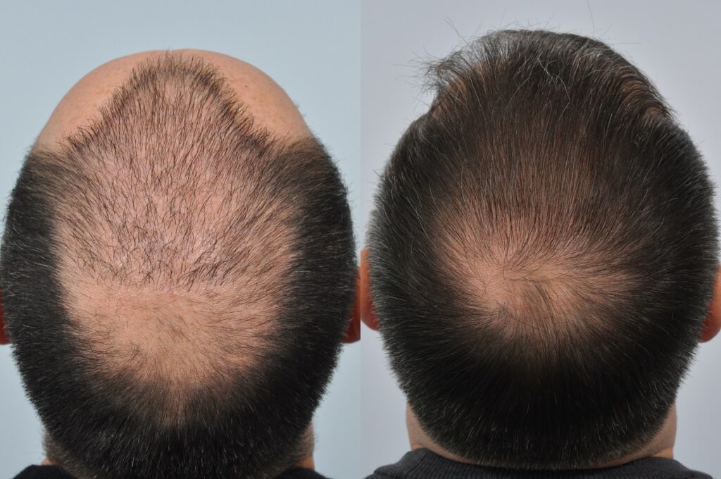 Implantation de cheveux