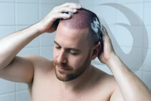 shampoing post greffe capillaire