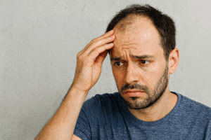 greffe de cheveux ratée