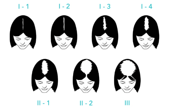 perte cheveux femme