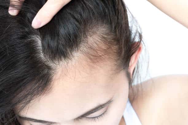 Perte de cheveux chez les jeunes femmes : quelles en sont les causes ?