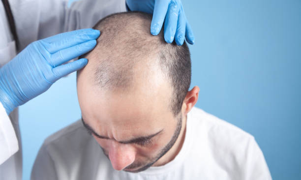Le traitement contre la perte de cheveux au Blanc-Mesnil