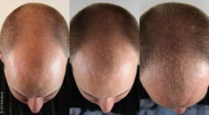 Traitement contre la perte / chute de cheveux homme et femme