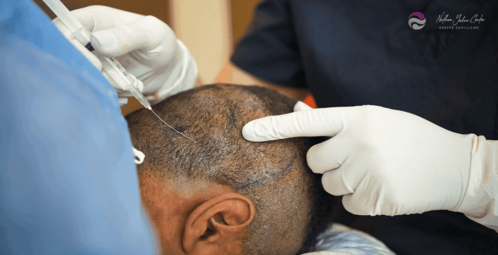 greffe de cheveux FUE