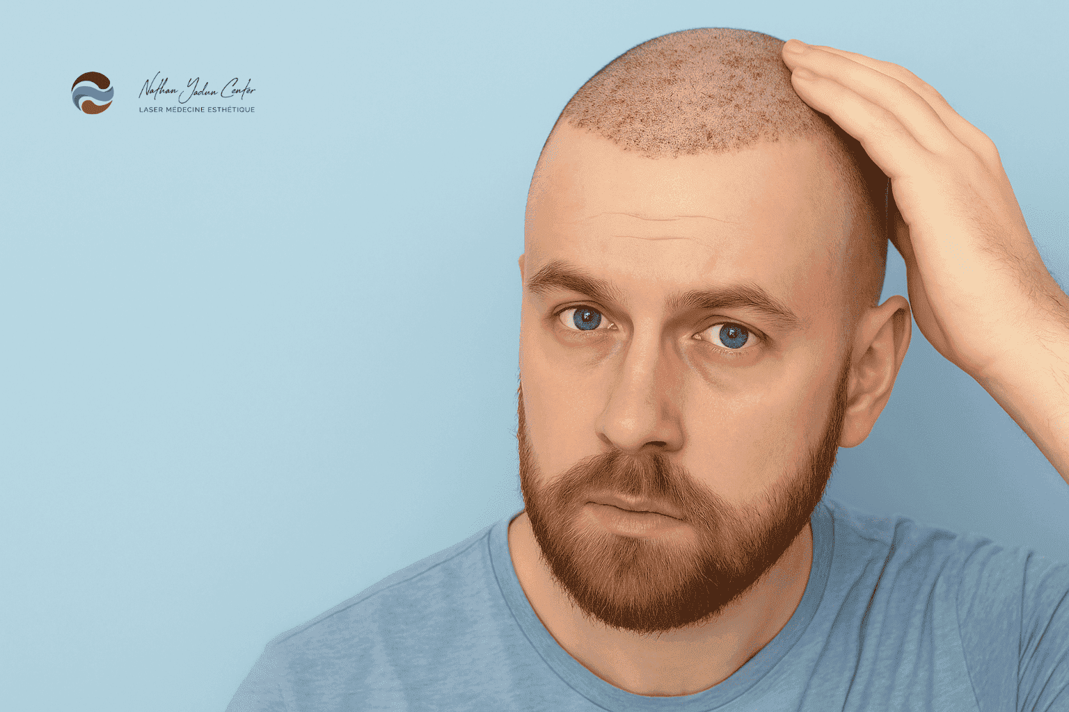 Récupération après une greffe de cheveux