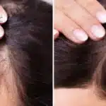 traitement perte de cheveux sans chirurgie