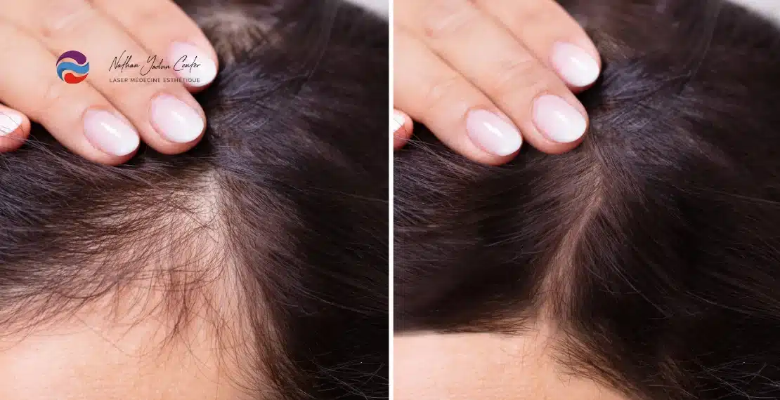 traitement perte de cheveux sans chirurgie