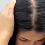 Alopécie femme : causes, traitements et solutions pour la pelade féminine