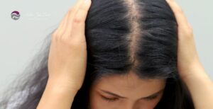 Alopécie femme : causes, traitements et solutions pour la pelade féminine