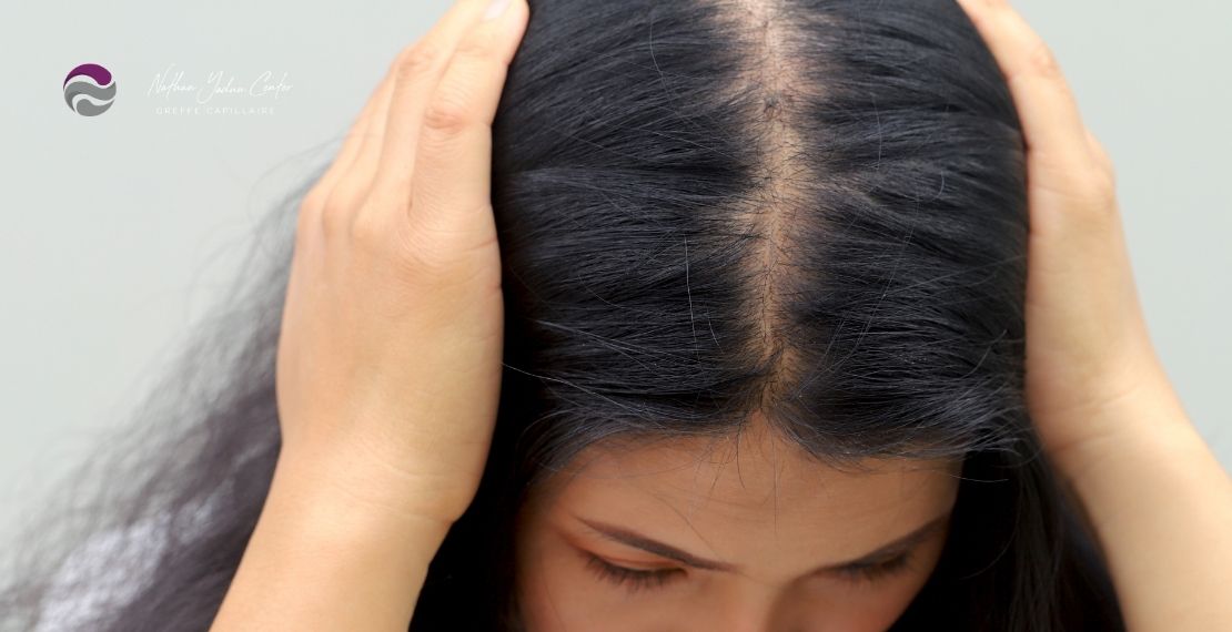 Alopécie femme : causes, traitements et solutions pour la pelade féminine