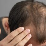 Alopécie homme : causes, traitements efficaces et solutions durables