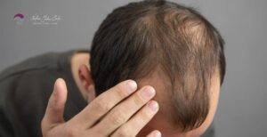 Alopécie homme : causes, traitements efficaces et solutions durables