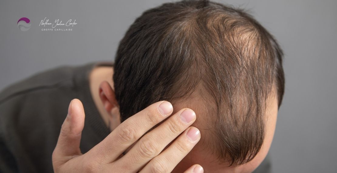 Alopécie homme : causes, traitements efficaces et solutions durables