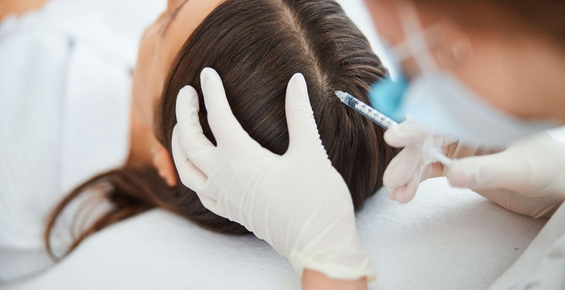 Mésothérapie cheveux solution efficace contre la chute capillaire