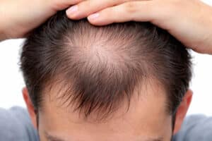 Calvitie homme - causes, stades et solutions