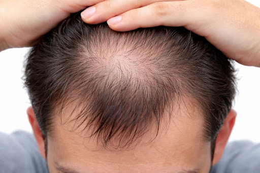 Calvitie homme - causes, stades et solutions