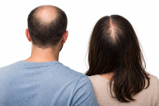 La calvitie - définition, causes et options de traitement