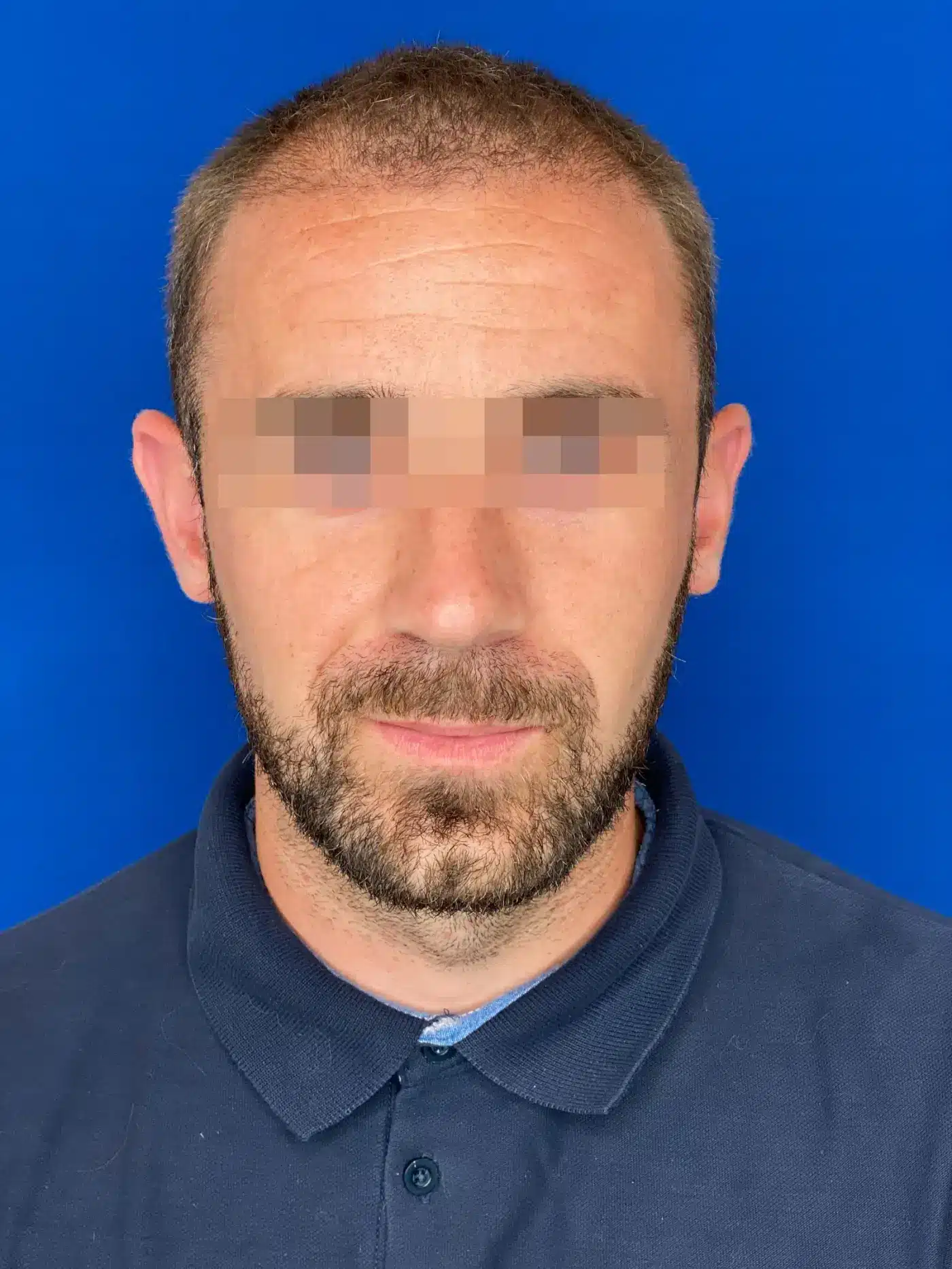 Patient un mois après sa greffe capillaire, photographie clinique anonymisée