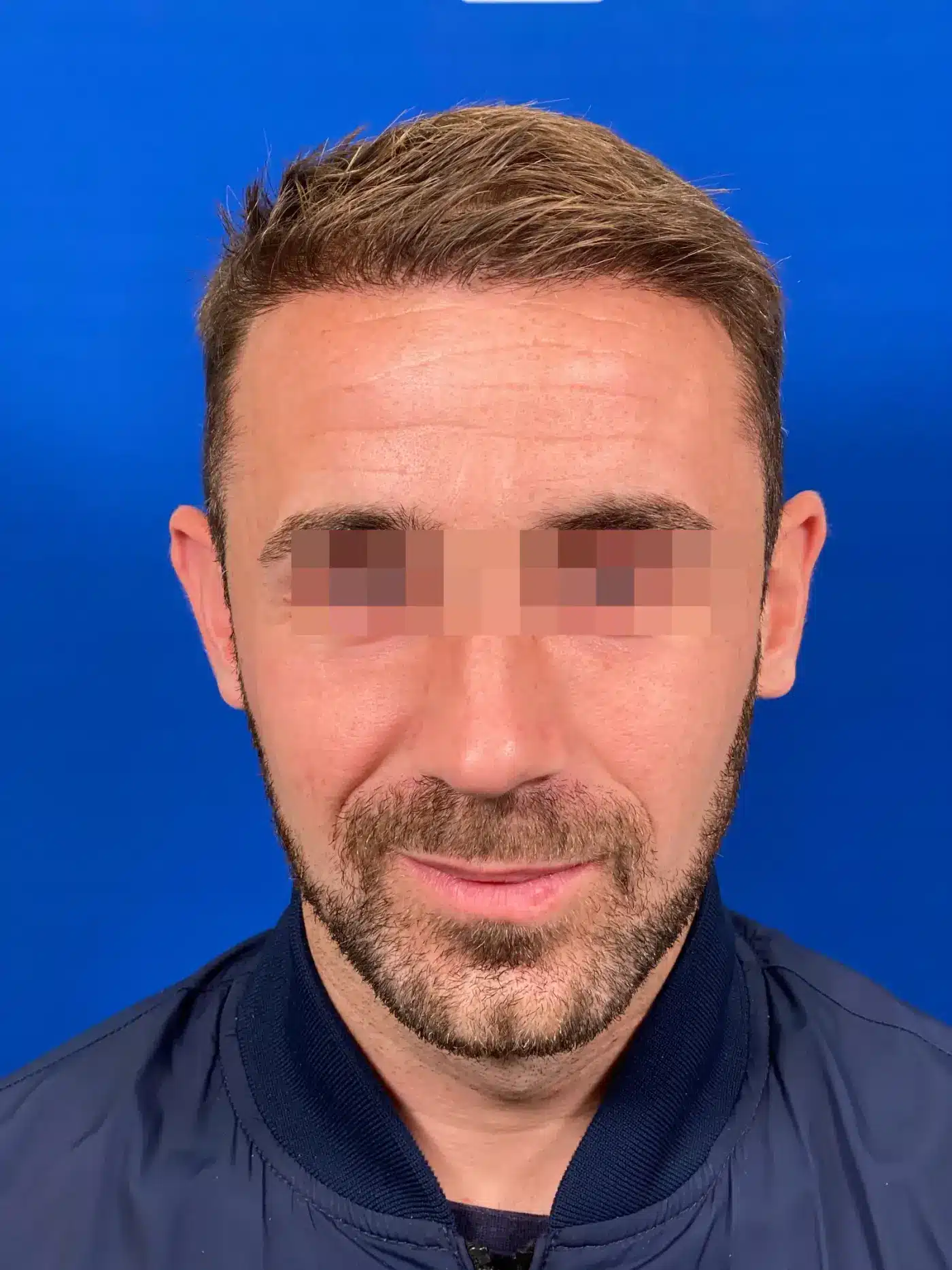 Évolution intermédiaire du patient neuf mois après sa greffe capillaire, photographie clinique anonymisée