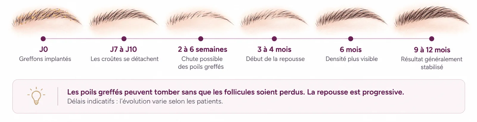 Chronologie de la repousse après une greffe de sourcils : J0 greffons implantés ; J7 à J10 les croûtes se détachent ; 2 à 6 semaines chute possible des poils greffés ; 3 à 4 mois début de la repousse ; 6 mois densité plus visible ; 9 à 12 mois résultat généralement stabilisé