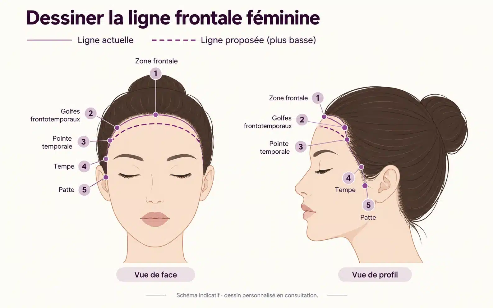 Dessin de la ligne frontale féminine de face et de profil : zone frontale, golfes frontotemporaux, pointe temporale, tempe et patte ; ligne actuelle en trait plein, ligne proposée plus basse en pointillés