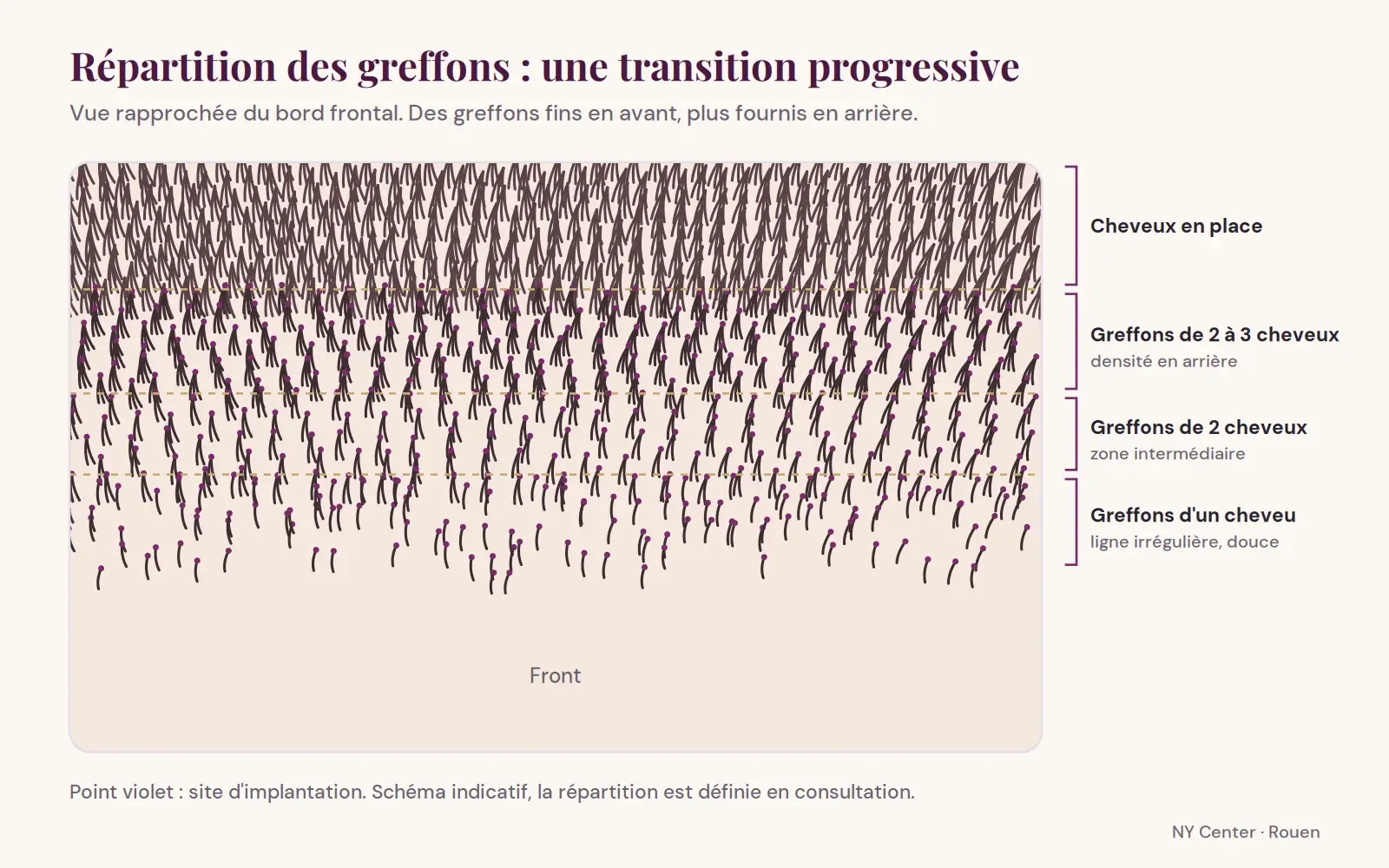 Schéma de répartition des greffons : greffons d'un cheveu en bordure, greffons de deux à trois cheveux en arrière pour une transition progressive