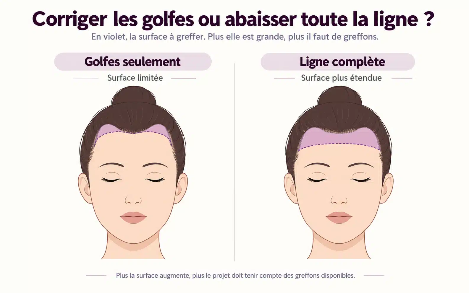 Comparaison de face : correction des golfes seuls, surface à greffer limitée, et abaissement de toute la ligne frontale, surface plus étendue, zones à greffer en violet