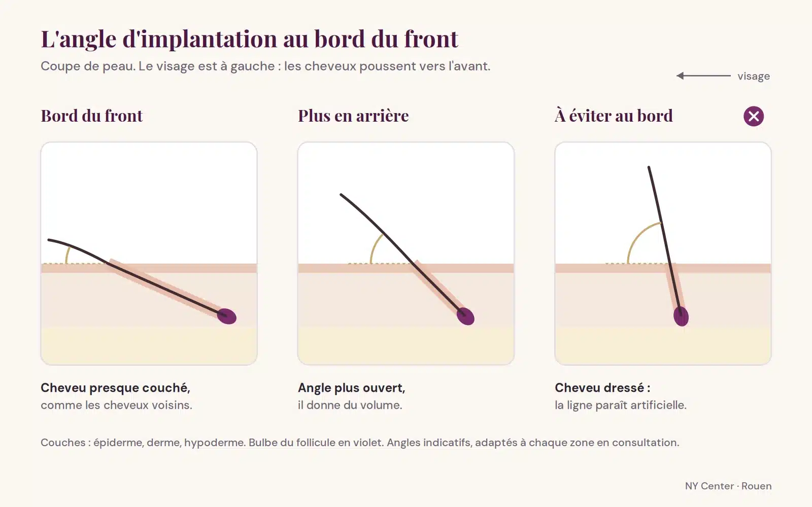 Coupe de peau montrant trois angles d'implantation : cheveu presque couché au bord du front, angle plus ouvert en arrière, cheveu dressé à éviter
