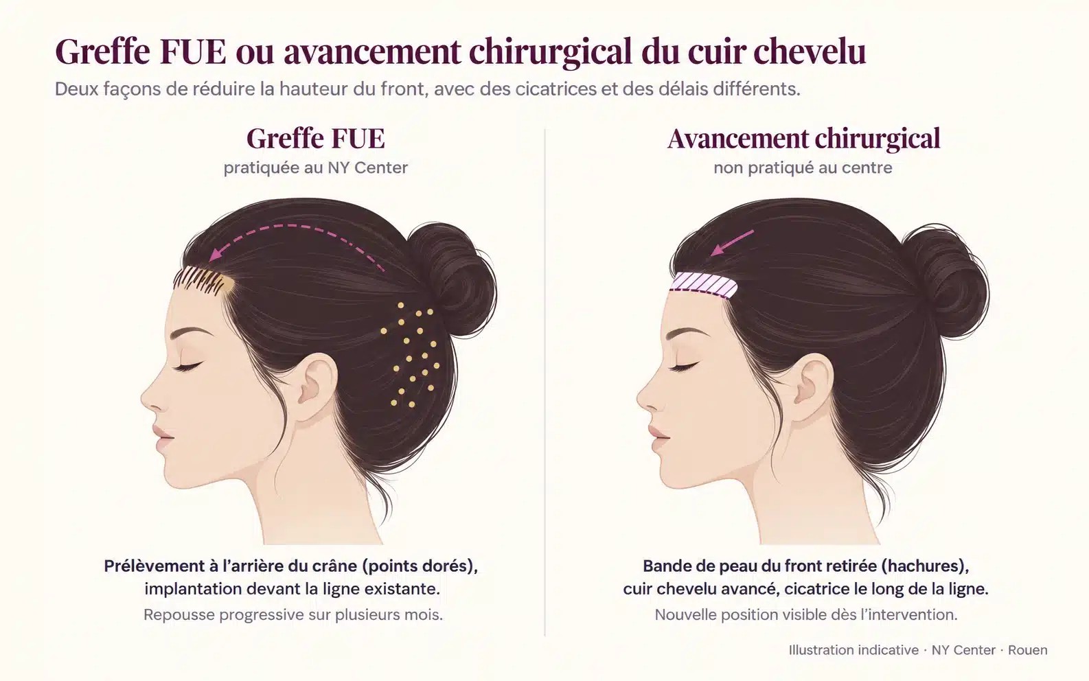 Comparaison de profil : greffe FUE avec prélèvement à l'arrière du crâne et implantation devant la ligne, et avancement chirurgical avec retrait d'une bande de peau du front et cicatrice le long de la ligne