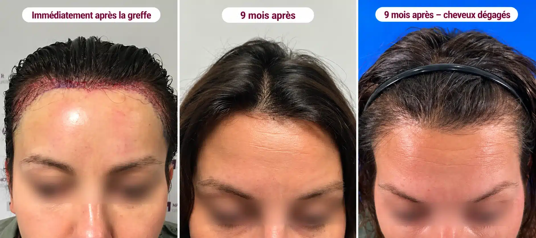 Patiente opérée au NY Center pour abaisser la ligne frontale : juste après la greffe, puis neuf mois plus tard, cheveux coiffés et cheveux dégagés par un bandeau