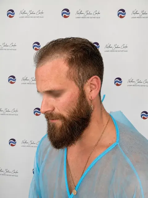 Cas 08 : avant la greffe de cheveux