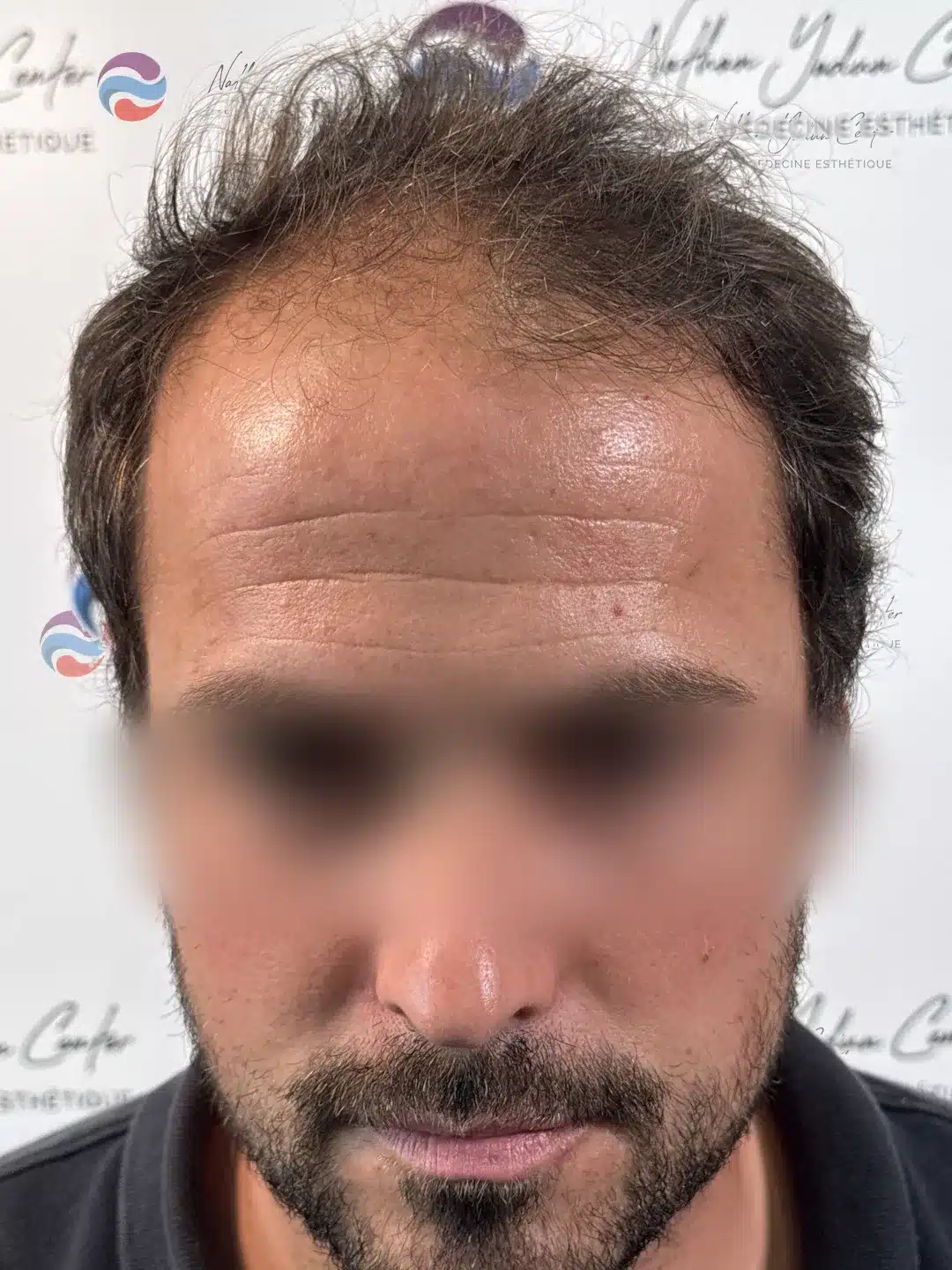 Avant la greffe — Zone antérieure, homme, 36 ans