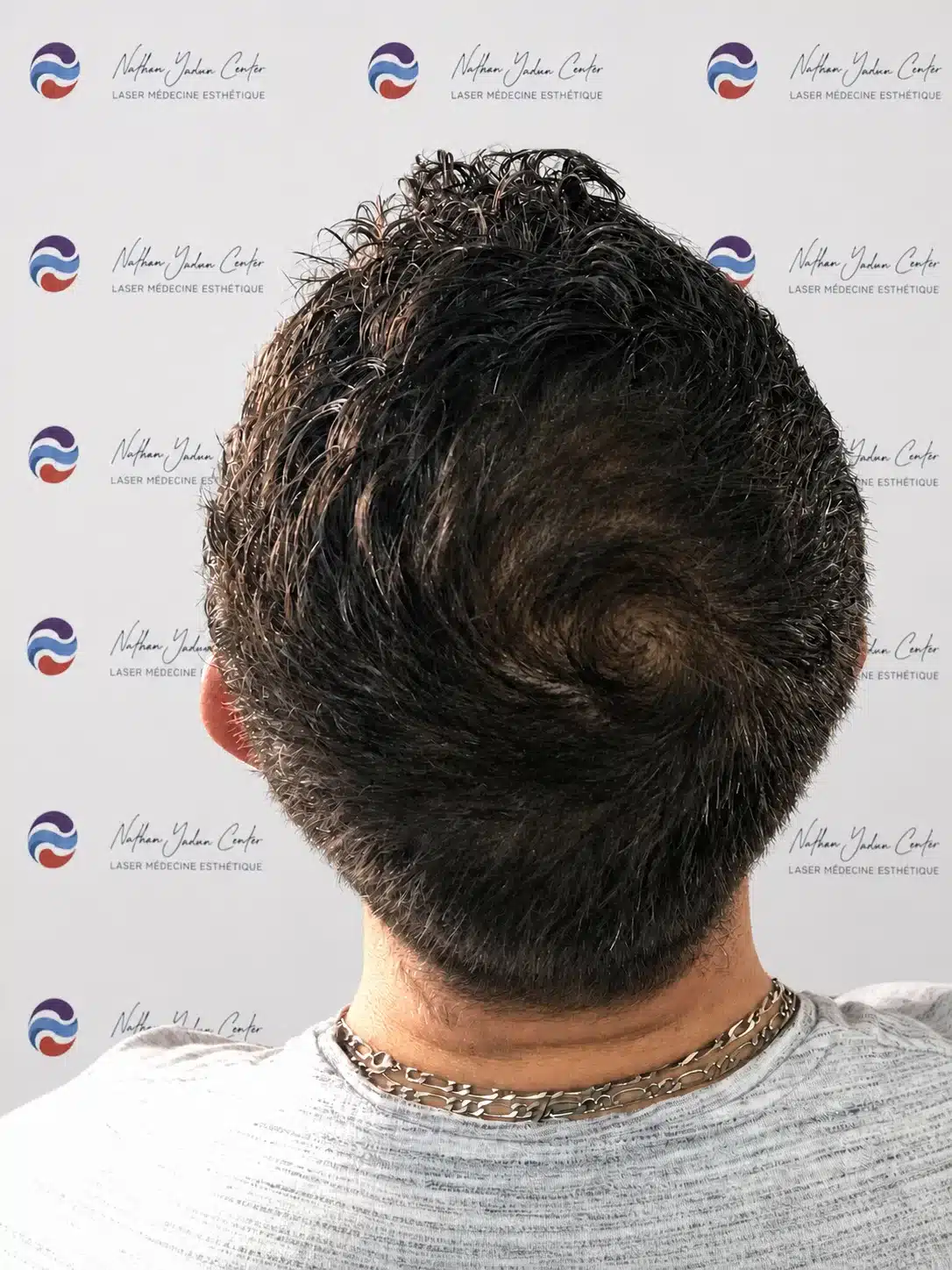 Après la greffe — Tonsure, à 12 mois