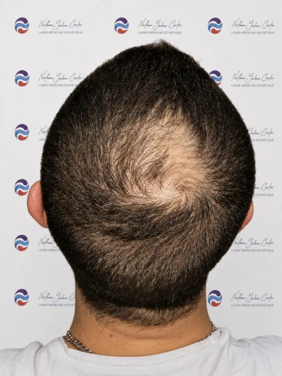 Avant la greffe — Tonsure, homme, 42 ans