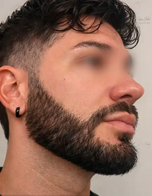 Après la greffe — Barbe, à 6 mois