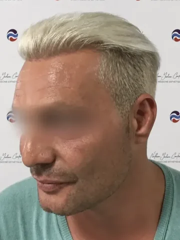 Même patient 12 mois après sa greffe de cheveux : résultat sur la ligne frontale