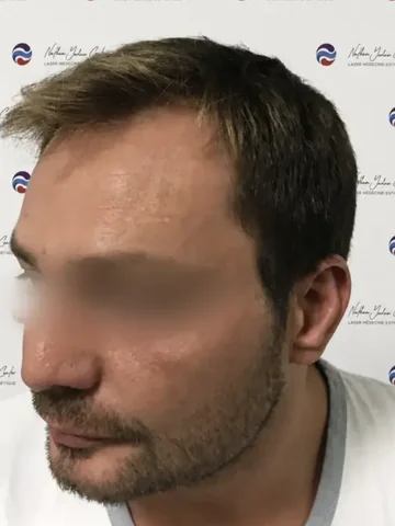 Patient avant sa greffe de cheveux : ligne frontale vue de trois quarts