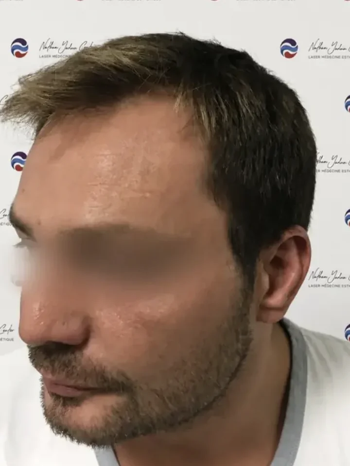 Cas 12 : avant la greffe de cheveux