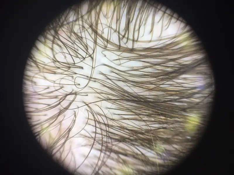 Observation du cuir chevelu au microscope optique