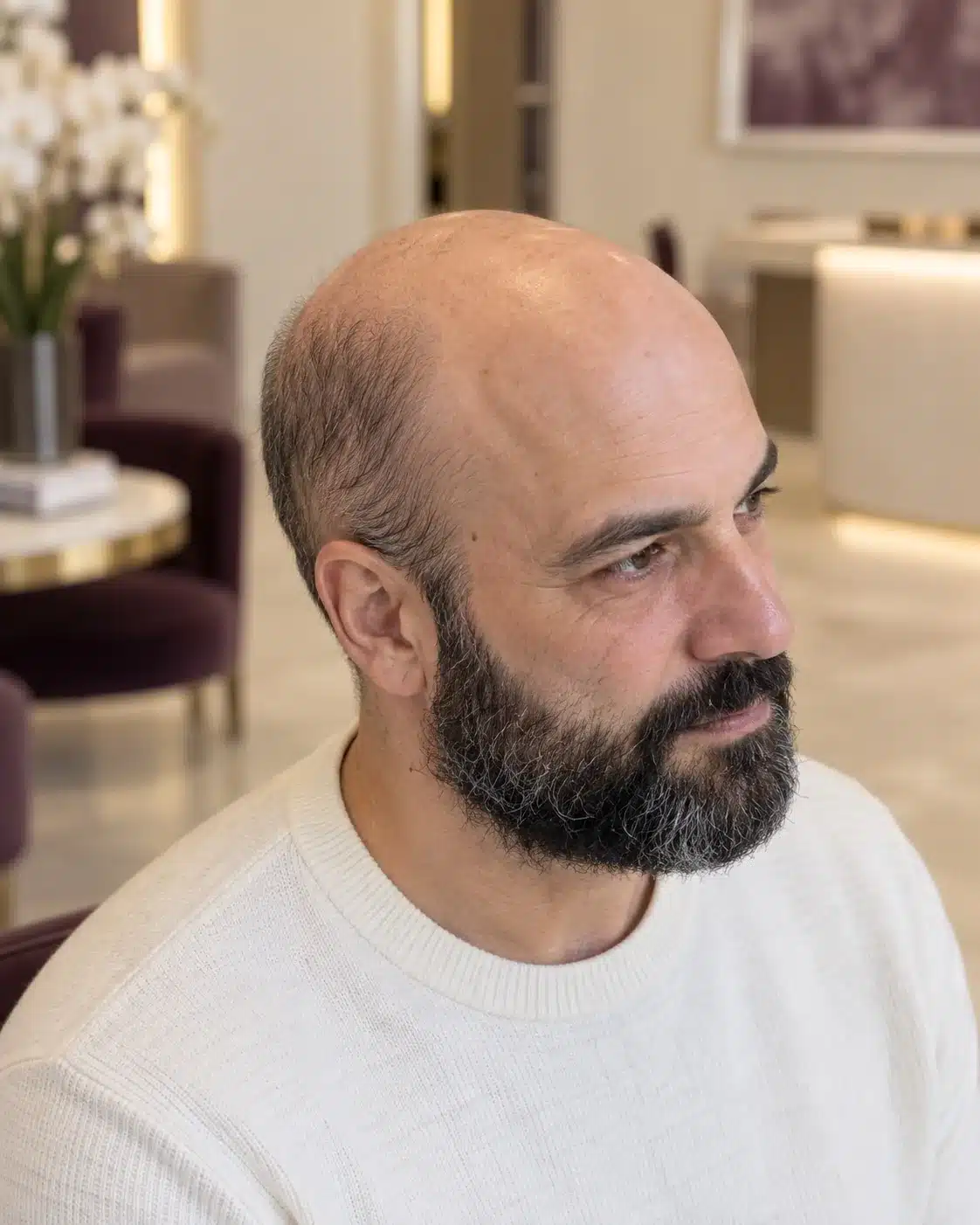 Homme à la barbe fournie, illustration de la zone donneuse en greffe BHT