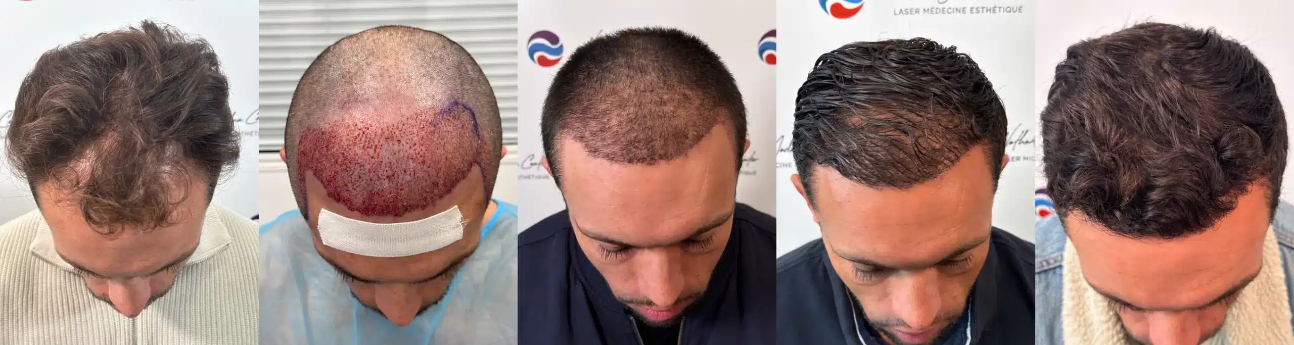 Greffe de cheveux de 3 000 greffons au NY Center : avant la greffe, immédiatement après l’intervention, puis à 1 mois, 5 mois et 9 mois