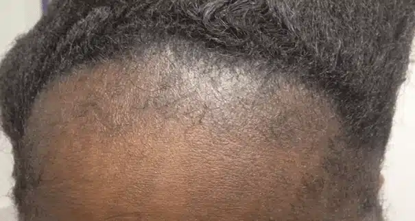 Illustration d’une perte de cheveux sur une zone soumise à la traction