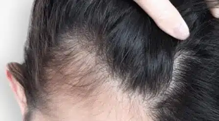 Illustration d’une chute diffuse des cheveux