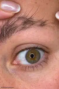 Greffe de sourcils ratée