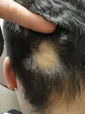 Autre illustration d’une perte de cheveux en plaques