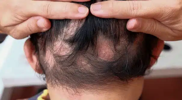 Exemple illustratif d’une perte de cheveux en plaques